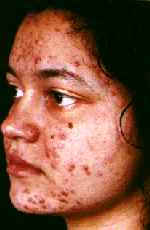 ACNE ANTES